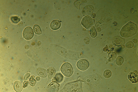 Cellule epiteliali urine