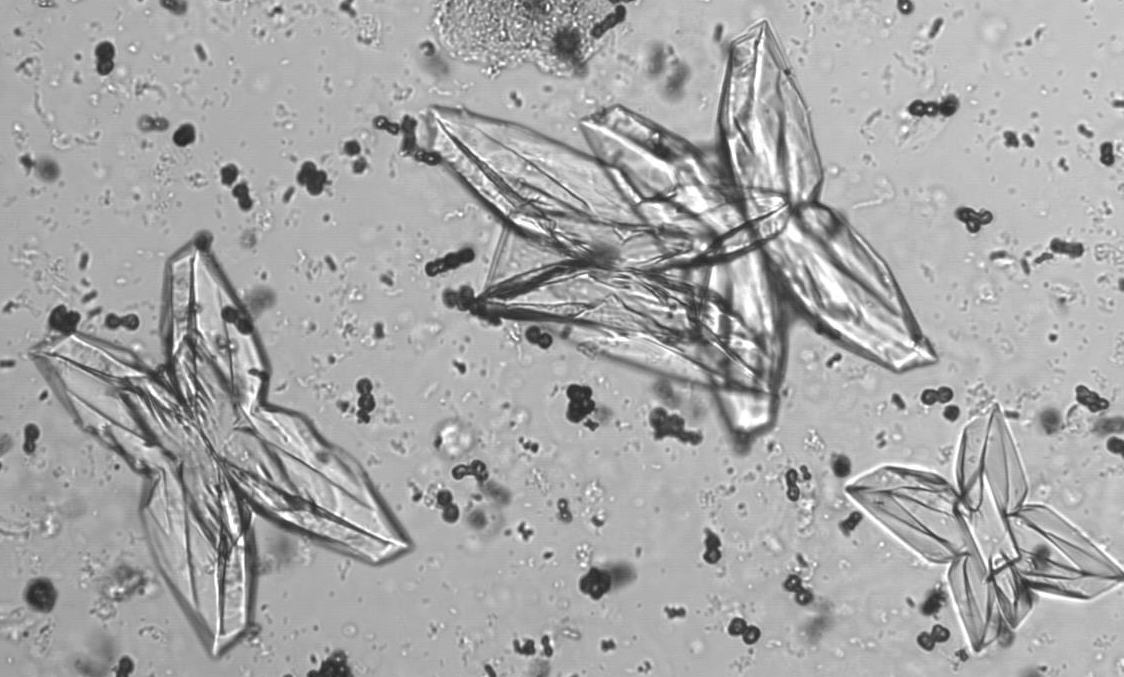 cristallo fosfato infezioni urinarie cristallo fosfato infezioni urinarie