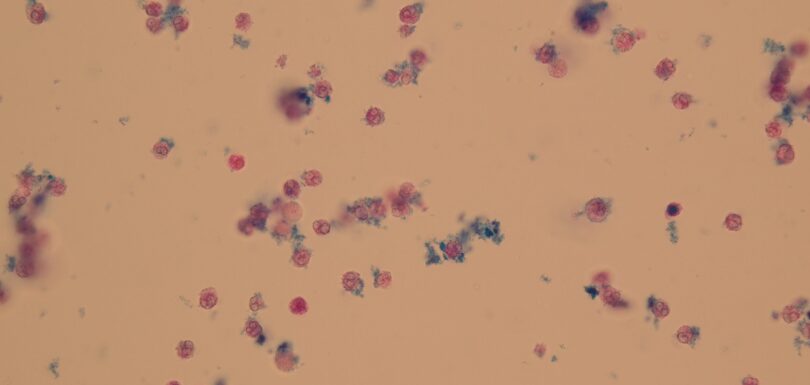 Leucociti nelle urine